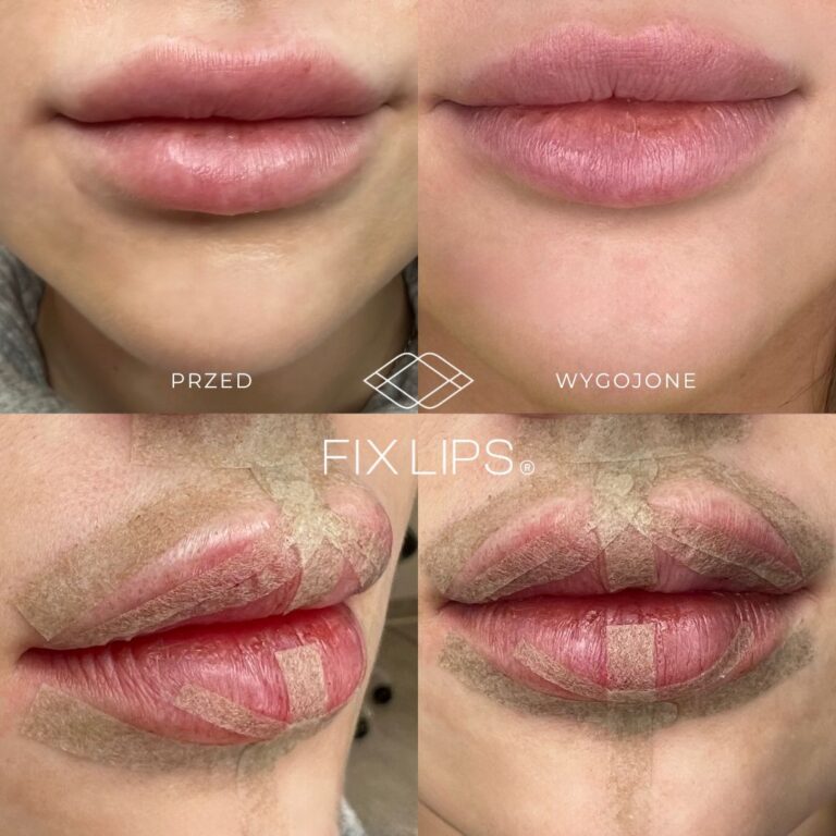 Fix Lips® - obrazek 8