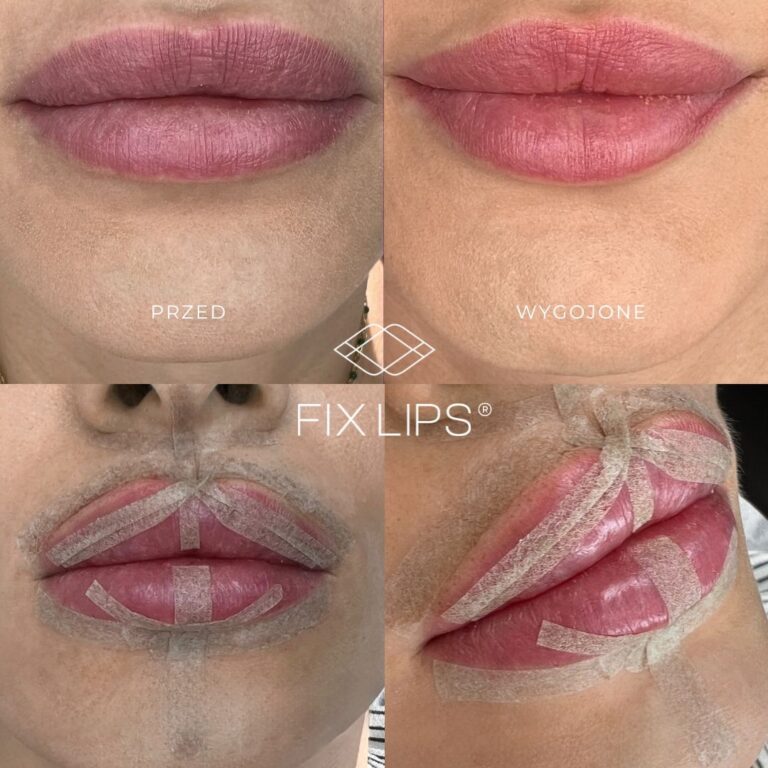 Fix Lips® - obrazek 7