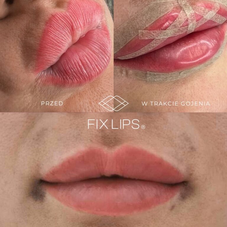 Fix Lips® - obrazek 6