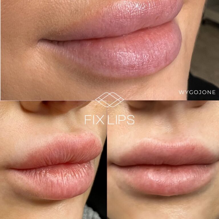 Fix Lips® - obrazek 5