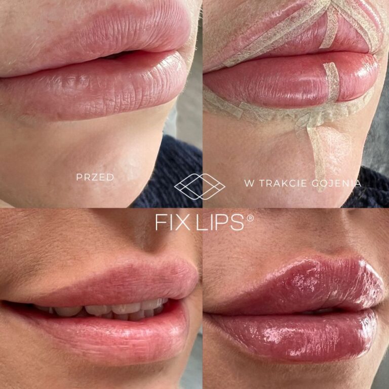 Fix Lips® - obrazek 2
