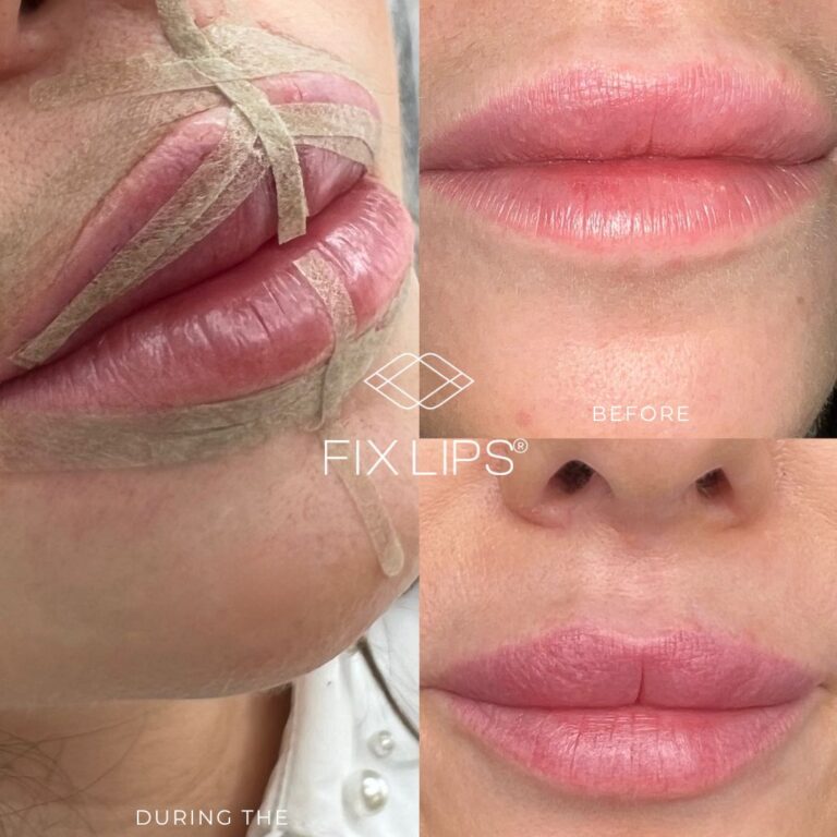 Fix Lips® - obrazek 4