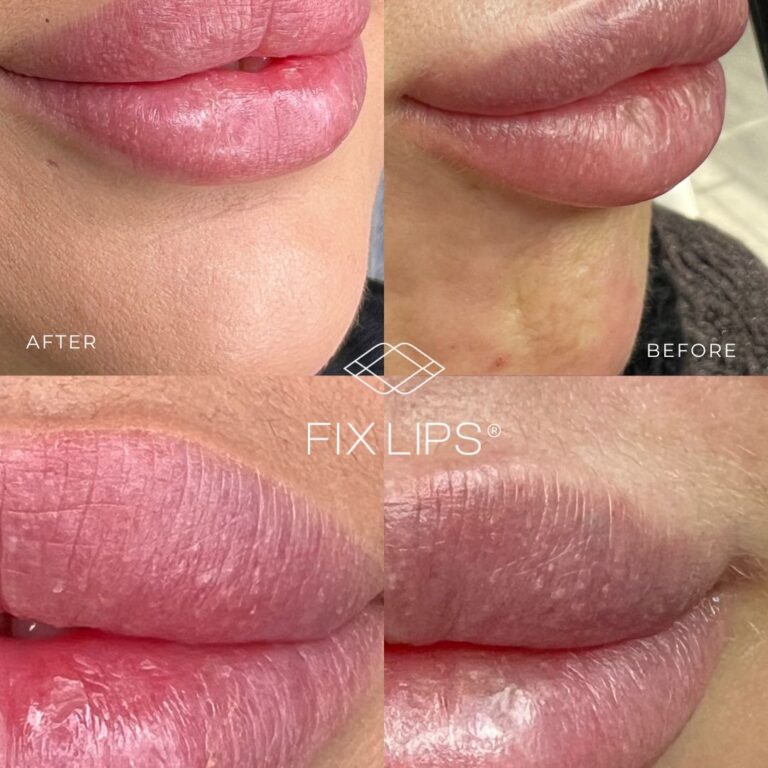 Fix Lips® - obrazek 3
